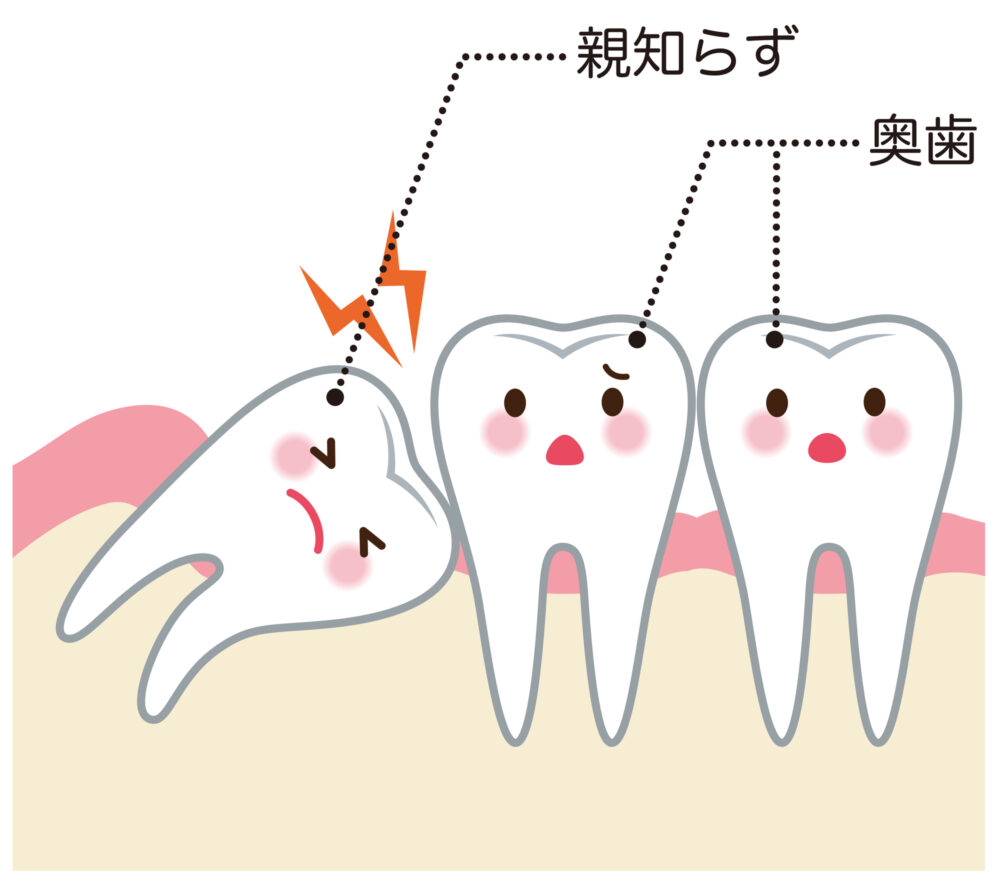 トラブルの原因となる親知らず