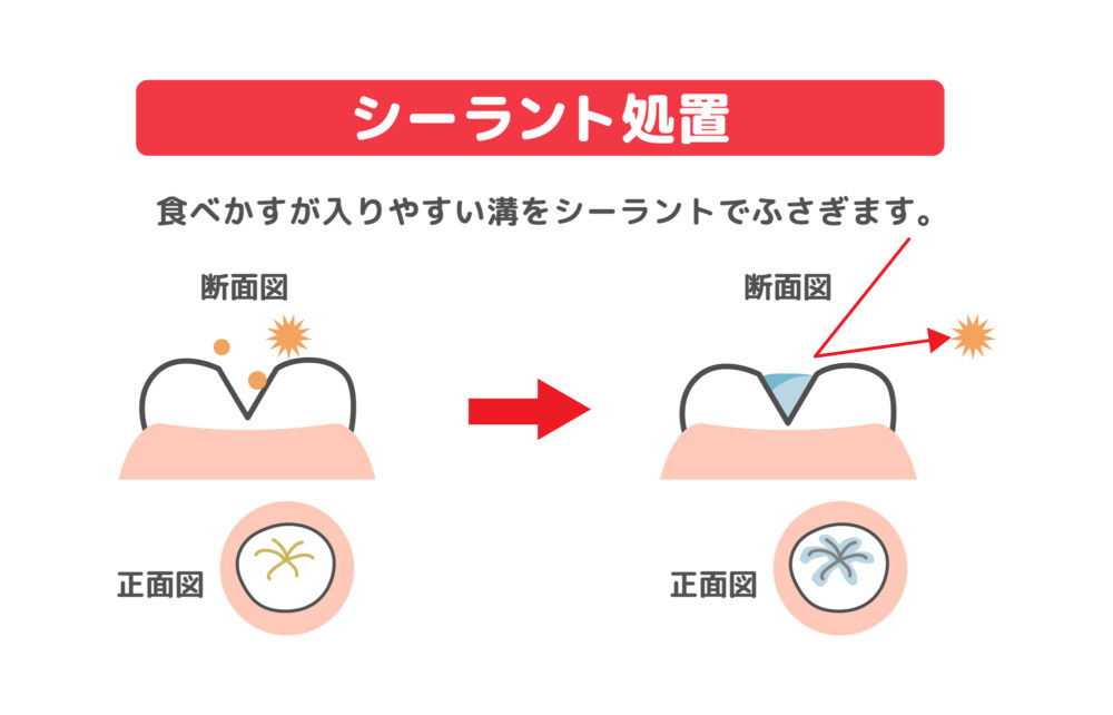 3.シーラント